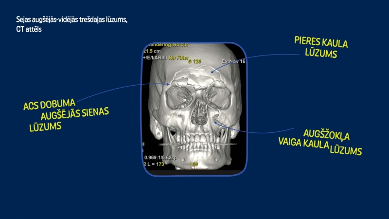Lauzti galvas kauli un metāla plāksnes sejā uz mūžu – sekas braukšanai ar elektroskrejriteni reibumā