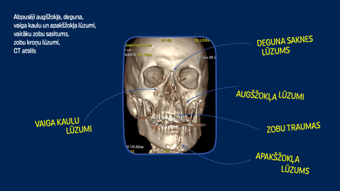 Lauzti galvas kauli un metāla plāksnes sejā uz mūžu – sekas braukšanai ar elektroskrejriteni reibumā